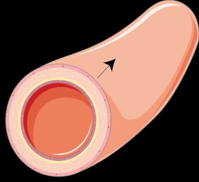 Vasodilation vessels